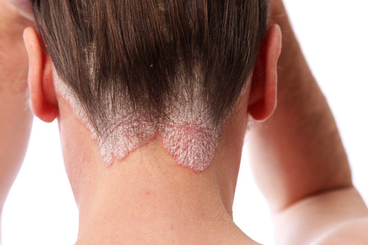Shampoo For Psoriasis Itchy Scalp 250ml Soothe Itching Burning Flaky Naturally - Herbalshire Handmade Herbal Products