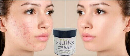 Sulphur Cream for Acne Eczema Rosacea – Natural Spot Treatment – Made in UK - Herbalshire Handmade Herbal Products