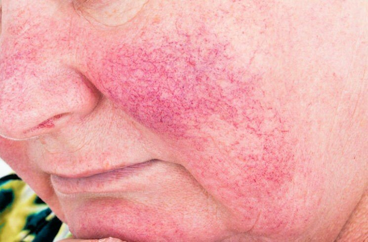 Sulphur Soap 200g Bar Natural Acne Treatment Eczema & Rosacea Relief Antifungal - Herbalshire Handmade Herbal Products