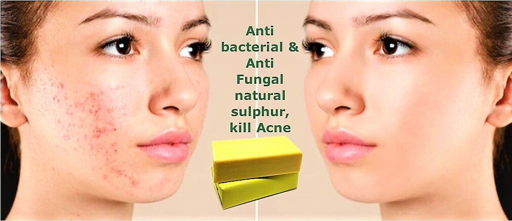Sulphur Soap 200g Bar Natural Acne Treatment Eczema & Rosacea Relief Antifungal - Herbalshire Handmade Herbal Products