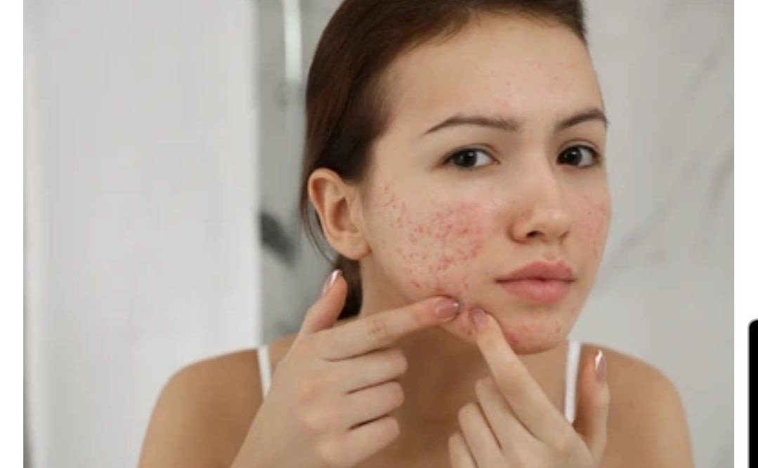 Sulphur Soap 3 Pack x 200g & Sulphur Cream set - Enriched with Vitamin E, Suita - Herbalshire Handmade Herbal Products