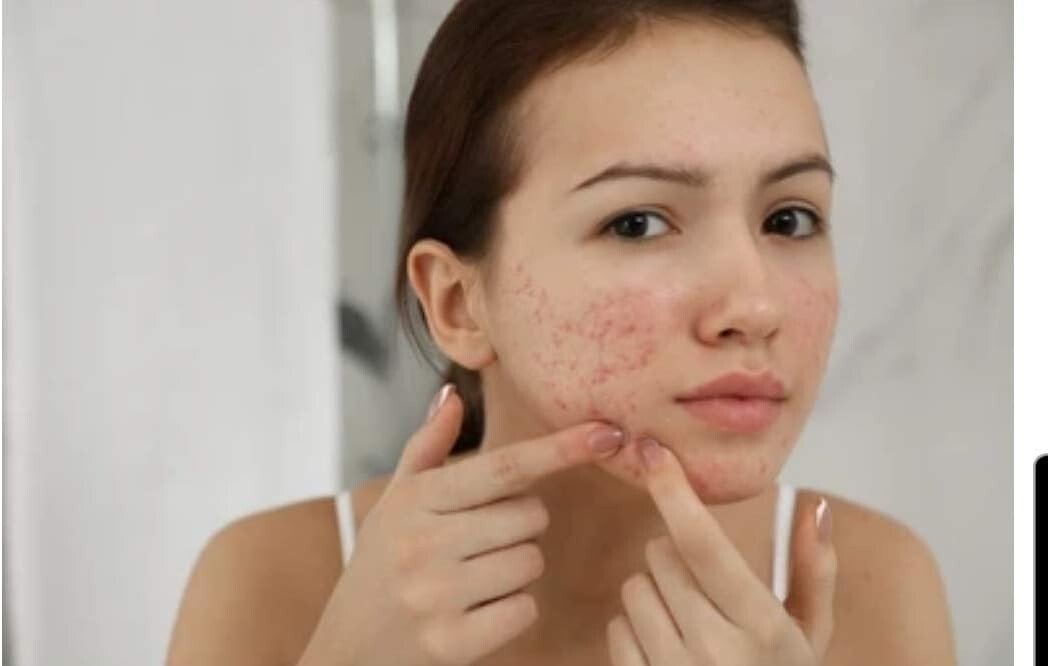 Sulphur Soap 5 - Pack (200g each) & Cream Vitamin E Enriched Vegan Acne Eczema - Herbalshire Handmade Herbal Products