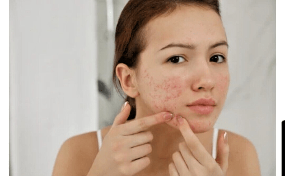 Sulphur Soap Bar 200g – Natural Acne, Rosacea, Eczema & Fungal Treatment UK - Herbalshire Handmade Herbal Products