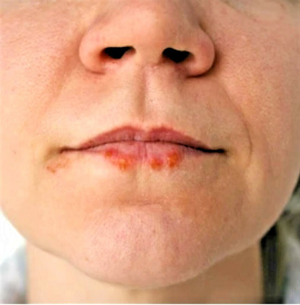 Tea Tree Cream for Acne Face & Skin Natural Antiseptic Balm 60ml 200ml UK Made - Herbalshire Handmade Herbal Products