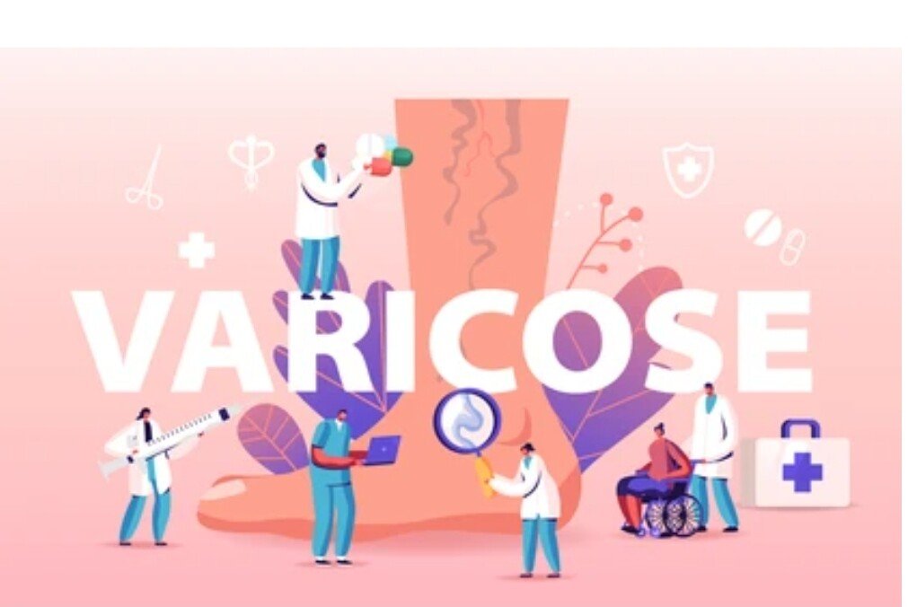 Varicose Vein Cream Vein Care Fading Cream Vein Cream Spider Veins Scars Soothe - Herbalshire Handmade Herbal Products