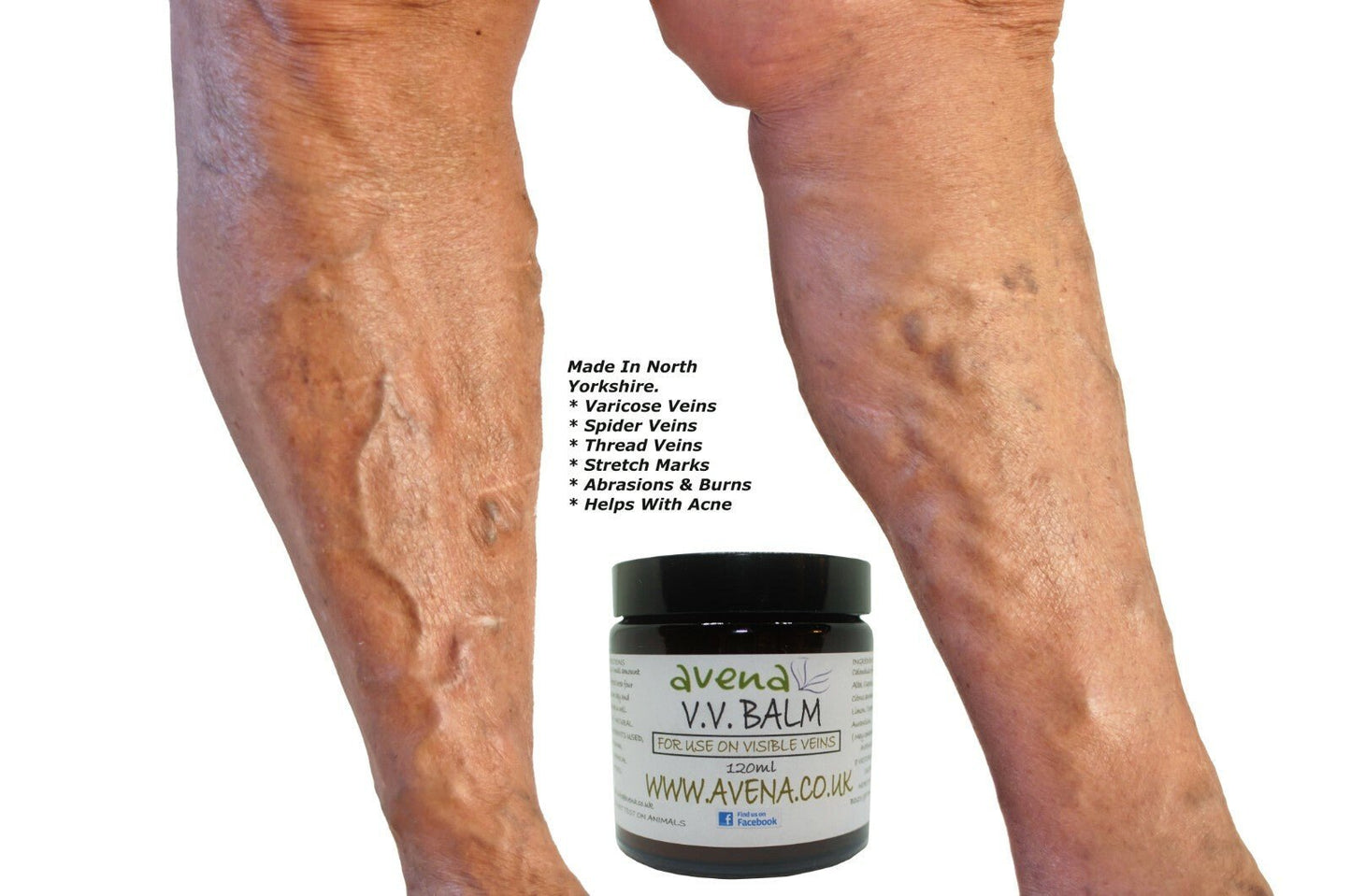 Varicose Vein Cream Vein Care Fading Cream Vein Cream Spider Veins Scars Soothe - Herbalshire Handmade Herbal Products