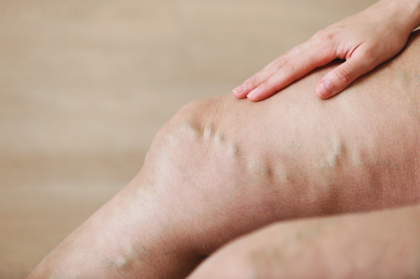 VV Calendula Balm - Natural Treatment for Visible Veins and Skin Conditions - Herbalshire Handmade Herbal Products