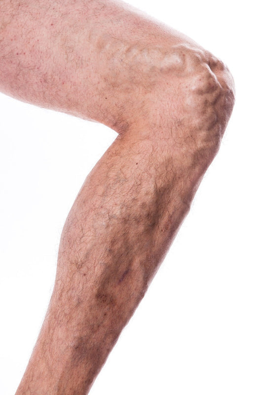 VV Calendula Balm - Natural Treatment for Visible Veins and Skin Conditions - Herbalshire Handmade Herbal Products