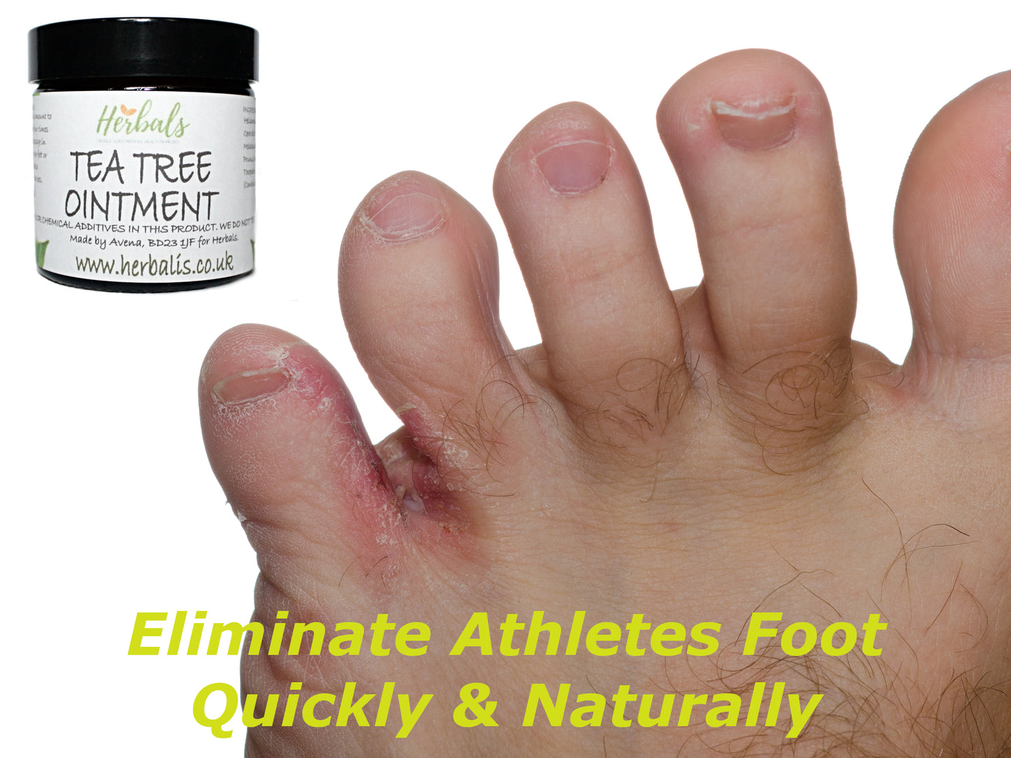 Tea Tree Cream Athletes Foot