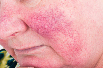 Herbalshire Natural Sulphur Cream - Vegan & Cruelty-Free - Acne, Scabies, Rosac