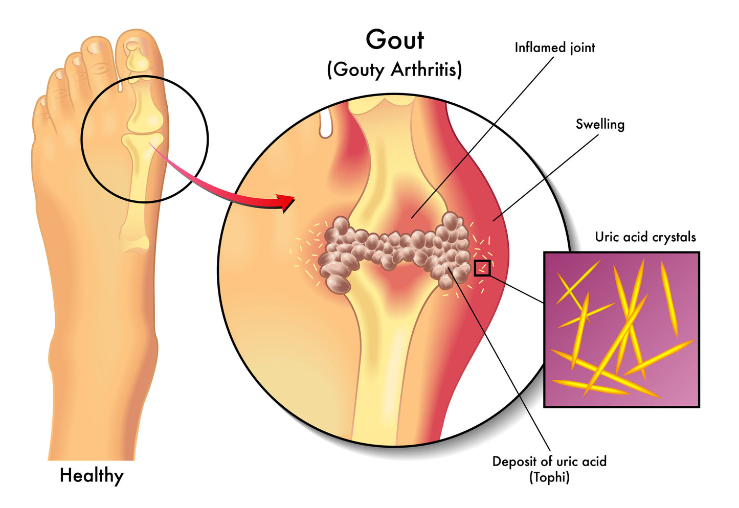 Gout Treatment Herbal Cream for Painful Gout Arthritis - Handmade in Yorkshire