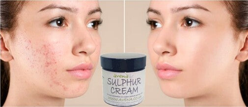 Sulphur Cream 35g for Skin - Ideal for Acne, Scabies, Eczema, and Rosacea - Soo