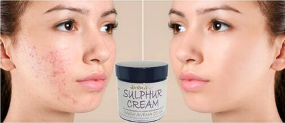 Sulphur Cream 35g for Skin - Ideal for Acne, Scabies, Eczema, and Rosacea - Soo