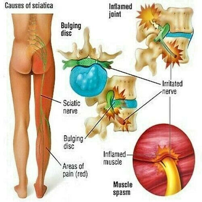 Sciatica Pain Relief Cream Reduce Painful Nerve Inflammation Shooting Pain