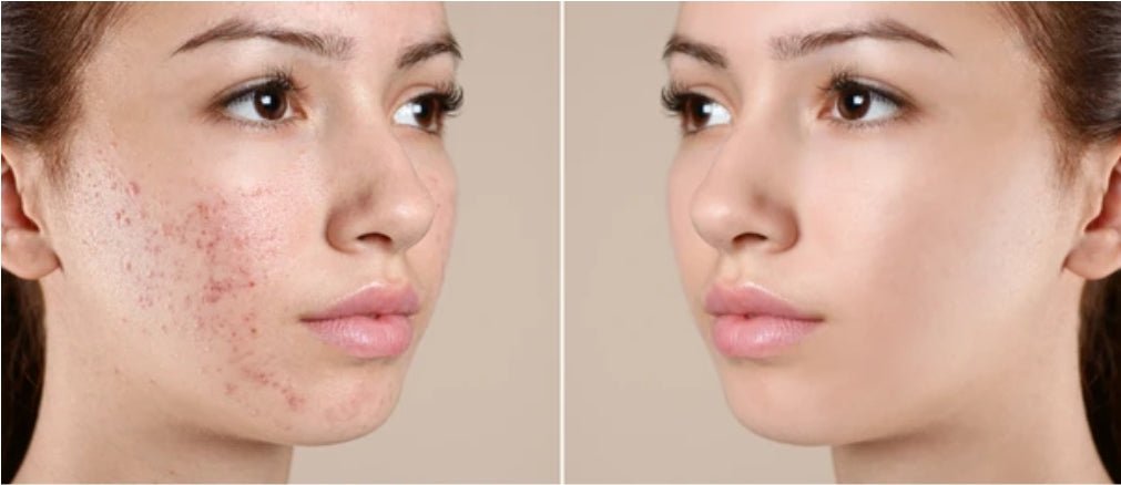 Close-up showing the soothing effects of sulphur soap on irritated skin